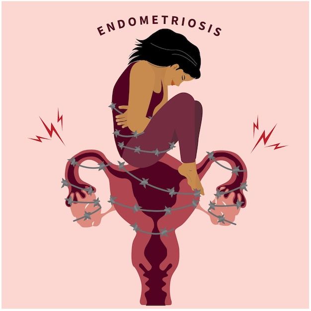 DISMINUYE EL DOLOR Y LA INFLAMACIÓN DE LA ENDOMETRIOSIS HASTA UN 80% EN 12 SEMANAS